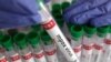 Une éprouvette étiquetée « mpox virus - positif » est tenue par un travailleur de la santé, le 20 août 2024. Reuters / Dado Ruvic