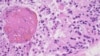 FILE - A high magnification image from a 2012 glioblastoma case is seen as an example in this College of American Pathologists image released from Northfield, Ill., July 20, 2017. 