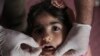 Rose Mohammed, 4, receives a polio vaccine at a kindergarten in Baghdad, Iraq, on April 10, 2014. 